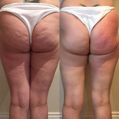 Necknix Ultrasonic Cavitation